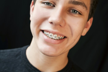 Fototapeta premium Portrait of close-up of a teenager who smiles on a black background. He has braces installed and he is not at all ashamed of it