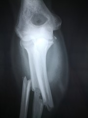 Röntgenbild nach Knochenbruch Arm