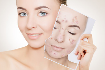 portrait of woman with clean skin holding portrait with pimpled skin