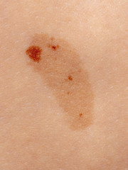 Birthmark on the skin of a person