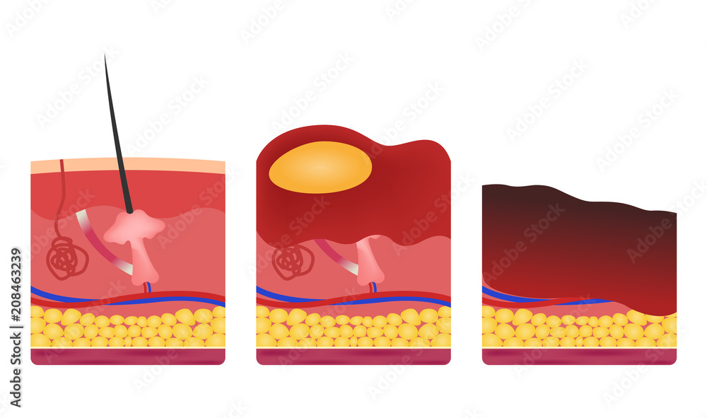 Wall mural step of burn . Normal to serious burn skin . vector and icon