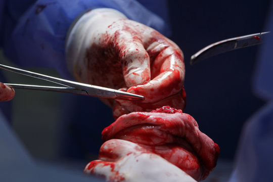 Surgeon holds the surgical thread by clamp sewing tissues of a hand stump after the mputation surgery MACRO