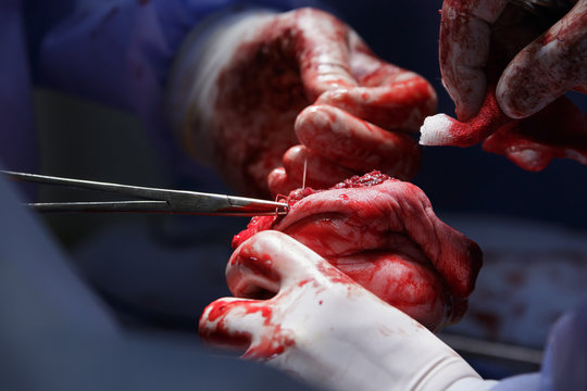 Surgeons sews the wound after the hand amputation macro