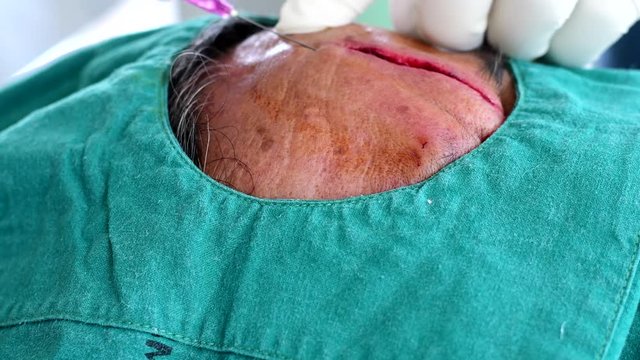 Doctor injections anesthetic before suturing cut wound at forehead. 
