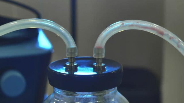 fat removal and Liposuction surgery Fat seeker. human fat in the glass after liposuction. Drain excess calories during surgery.