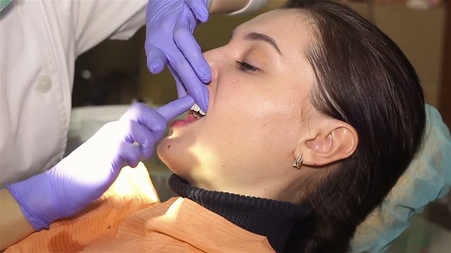 Young woman with an expander in mouth at the dental clinic. Application of protective whitening gel to the teeth.