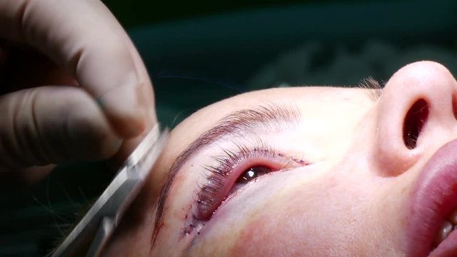 The doctor sutures a wound under the patient's eye during a plastic operation to rejuvenate the eyes. Plastic surgery for blepharoplasty.