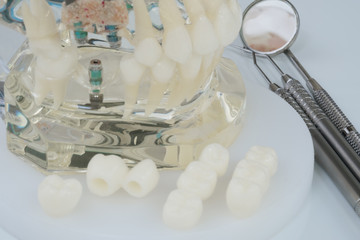 Fototapeta na wymiar implant and orthodontic model for student to learning teaching model showing teeth.