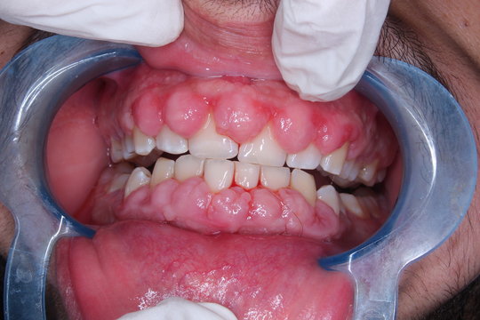 Drug Induced Gingival Enlargement