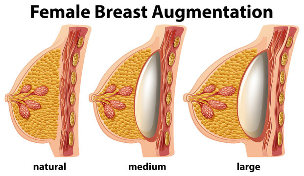 A Set of Female Breast Augmentation