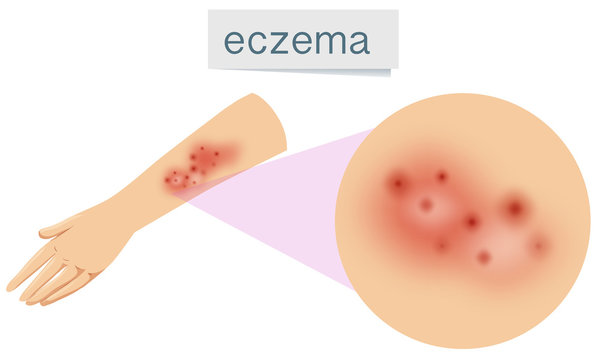 A Vector of Eczema on Skin