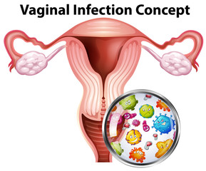 Vaginal infection bacteria concept