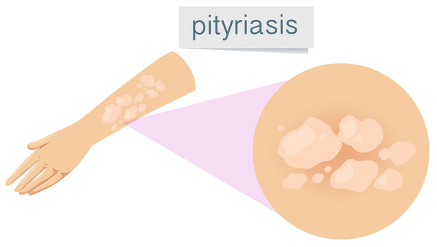 A Pityriasis on Human Skin