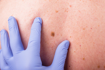 the doctor examines the birthmarks on the man's body