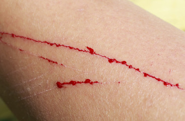 pain and itching from the wound and scratches with drops of blood on the human foot closeup