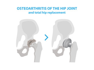 Osteoarthritis of the Hip Joint and Hip Replacement Surgery medical infographic elements isolated on white background. Joint with arthritis and replaces it with an artificial joint made from metal.