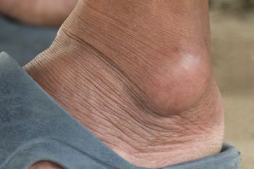 Close-up gout on a foot