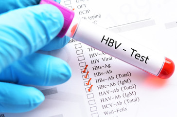 Blood sample tube with laboratory requisition form for HBV profile test