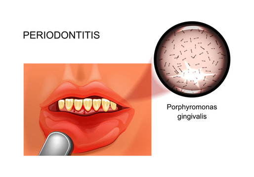 periodontitis. bleeding gums