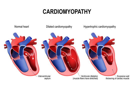 hypertrophic cardiomyopathy, dilated cardiomyopathy and healthy heart