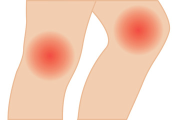 Fototapeta premium Knee joint pain vector illustration. hyperextension treatment 