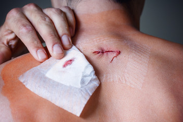 Wounded surgeon, injury on the back of a man, fresh scar, close-up, gray background