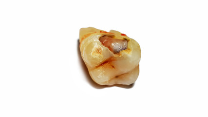 close-up tooth decay isolated on white background