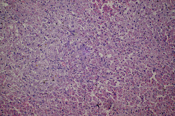 chronic obstruction of human liver