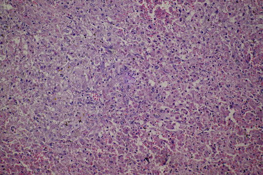 chronic obstruction of human liver