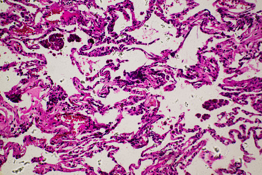 chronic obstruction of human lung