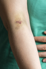 Bruise on woman's hands.