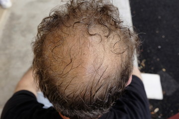 human head with baldness