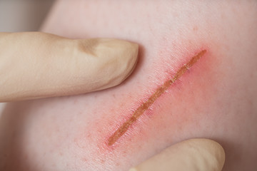 close up scar on skin