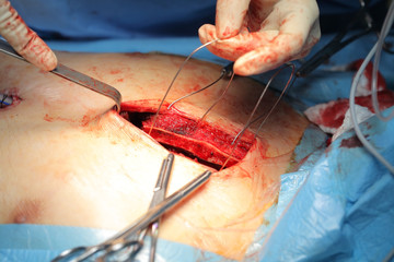 Surgeon carries out the osteosuture of the patient's sternum during surgery - obrazy, fototapety, plakaty