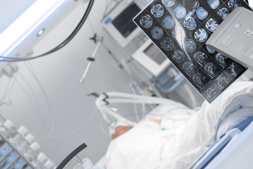 Comatose patient on the lung ventilator in the intensive care unit