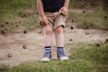 Small boy in shorts showing his broken children's knees