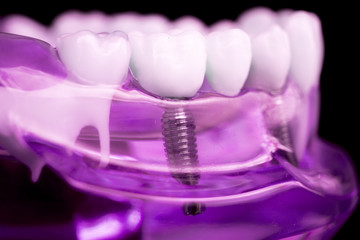 Dentist dental teeth implant