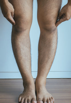 Asian man leg bandy-legged shape of the legs