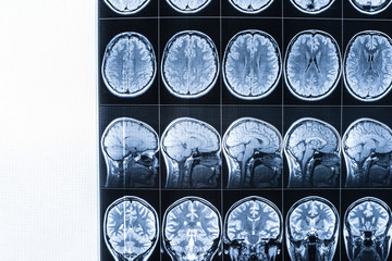 MRI of the head and brain