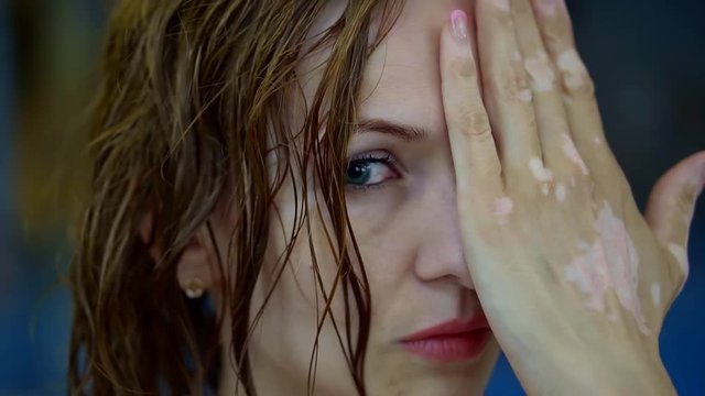 close up. face and palm of a middle-aged woman with vitiligo endocrine skin disease