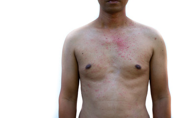 Fototapeta premium Rashes on human skin