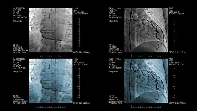 Medical display with four coronary angiograms on it