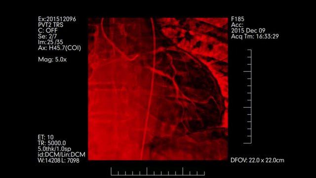 Red colored angiogram of heart vessels | Cardiovascular angiography