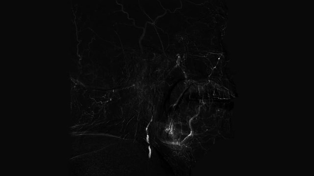 Black and white side view Brain vessels angiography.