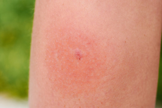 entzündeter Mückenstich an einer Mädchenwade