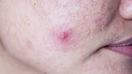 Woman skin face surface problem from acne