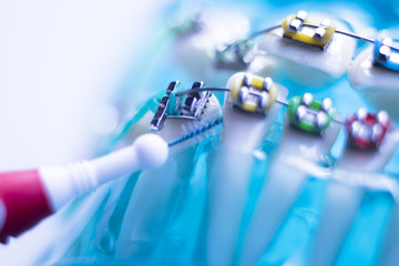 Interdental teeth brackets clean