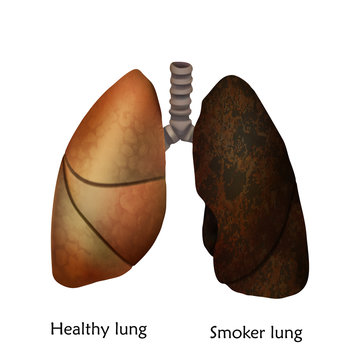 Human Lungs. Healthy Lung And Smoker Lung. Anatomy Vector Illustration. White Background.