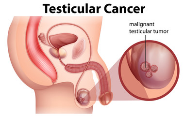 A Male Anatomy of Testicular Cancer