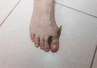Woman is wearing the toe correction device. Healthy treatment photo.